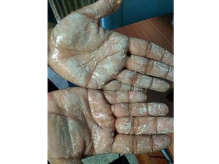 റേഷന്‍ അരിയിലും വ്യാജന്‍: ചൂടുവെള്ളത്തില്‍ കഴുകിയാല്‍ കൈകളില്‍ പ്ലാസ്റ്റിക്ക് കറ