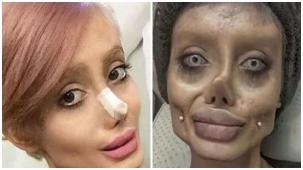 സൗന്ദര്യം കൂട്ടാന്‍ ശസ്ത്രക്രിയ നടത്തി പെട്ടു; ഇറാനിയന്‍ യുവതി അറസ്റ്റില്‍, 'ആഞ്ജലീന ജോളി'