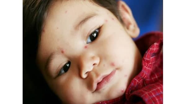 കോവിഡ്‌ 19ന്‌ പിന്നാലെ 2021ല്‍ മിസില്‍സ്‌ വൈറസ്‌ പൊട്ടിപ്പുറപ്പെട്ടേക്കാമെന്ന്‌‌ പഠനം