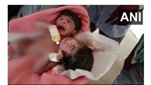 രണ്ടു തലകള്‍, മൂന്ന് കൈകള്‍... ഒട്ടിച്ചേര്‍ന്ന് ഇരട്ടകളുടെ അപൂര്‍വ ജനനം