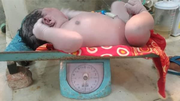 27കാരി പ്രസവിച്ച കുഞ്ഞിന്റെ തൂക്കം 5.2 കിലോ... അമ്പരന്ന് ഡോക്ടര്‍മാര്‍, ഇത്രയും ഭാരം ആദ്യം