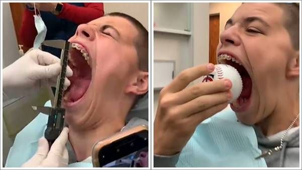 സോഡാ കുപ്പി മുതല്‍ ബേസ് ബോള്‍ വരെ ഈസിയായി കേറും, ലോകത്തിലെ ഏറ്റവും വലിയ വായ; റെക്കോര്‍ഡ്