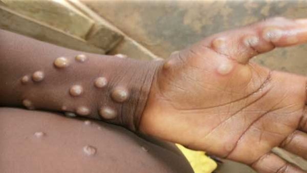 യൂറോപ്പിൽ കുരങ്ങ് പനി വ്യാപിക്കുന്നു; ചർച്ച ചെയ്യാൻ യോഗം വിളിച്ച് ലോകാരോഗ്യ സംഘടന