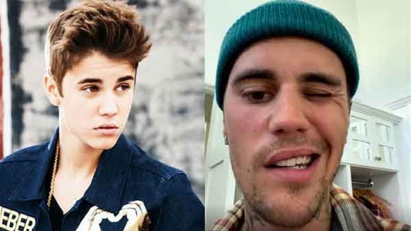 'കണ്ണ് ചിമ്മാനോ പുഞ്ചിരിക്കാനോ വയ്യ', ഗുരുതര രോഗം ബാധിച്ചെന്ന് ജസ്റ്റിന്‍ ബീബര്‍, ആരാധകര്‍ ഞെട്ടലില്‍