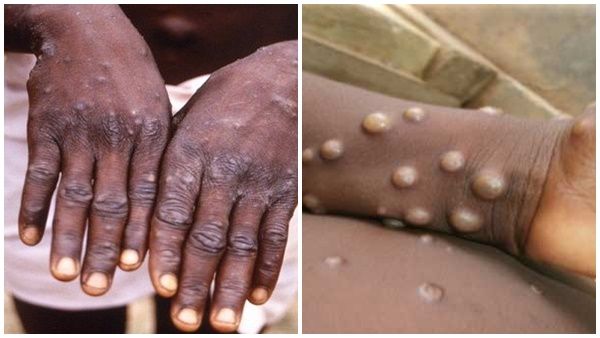 കുരങ്ങുപനി: സമ്പര്‍ക്കത്തില്‍ വന്നവരെ 21 ദിവസം നിരീക്ഷിക്കണം; മാര്‍ഗ നിര്‍ദേശങ്ങളുമായി കേന്ദ്രം