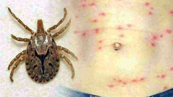 ഭീതി വിതച്ച് ചെള്ളുപനി; തിരുവനന്തപുരത്ത് വീണ്ടും മരണം