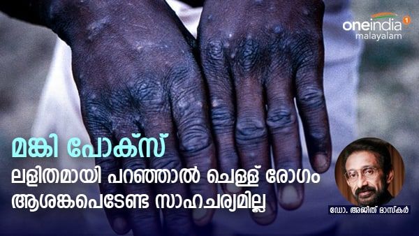 മങ്കി പോക്സ്; ആശങ്കപെടേണ്ട സാഹചര്യമില്ല, രോഗ്യവ്യാപന ശേഷി വളരെ കുറവ്: ഡോ. അജിത് പറയുന്നു