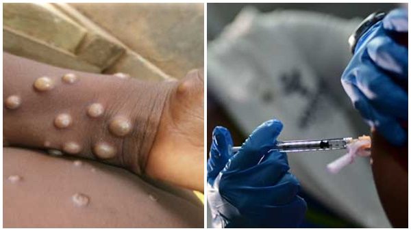 മങ്കി പോക്‌സ്: രോഗിക്കൊപ്പം യാത്ര ചെയ്ത രണ്ട് കോട്ടയം സ്വദേശികള്‍ നിരീക്ഷണത്തില്‍