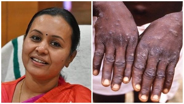 മങ്കിപോക്സ്:'ചികിത്സയിലുള്ള രോഗി സഹകരിക്കുന്നില്ല'; പ്രതികരിച്ച് വീണ ജോർജ്