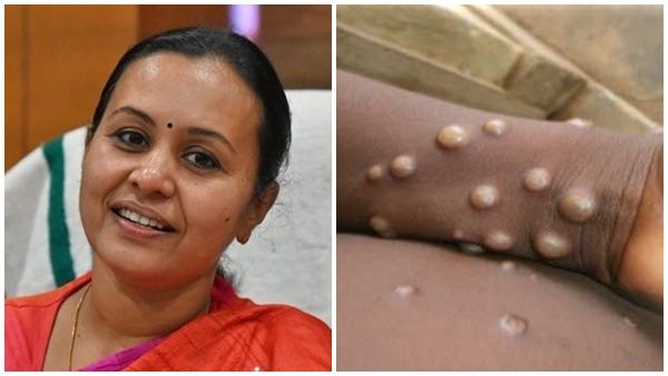 മങ്കിപോക്‌സ്: 'ചിക്കൻ പോക്സ് ലക്ഷണമുള്ളവരെ നിരീക്ഷിക്കും, കനിവ് 108 ആംബുലന്‍സ് സജ്ജം'; വീണാ ജോര്‍ജ്