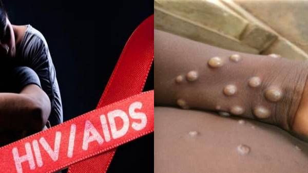 യുവാവിന് മങ്കിപോക്‌സും കോവിഡും എച്ച്‌ഐവിയും; ലോകത്ത് ആദ്യത്തെ കേസ്, അത്ഭുതം