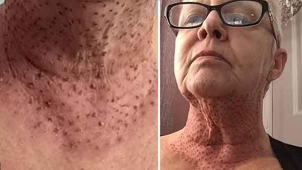 ഇരട്ടത്താടി ഒഴിവാക്കാന്‍ ചികിത്സ; ശേഷം പല്ലി ശരീരം പോലെ കഴുത്ത്, 59 കാരിയുടെ ദുരനുഭവം