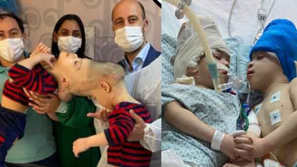 തലയോട്ടി ഒട്ടിച്ചേര്‍ന്ന ഇരട്ടകളെ വെര്‍ച്വല്‍ റിയാലിറ്റി ശസ്ത്രക്രിയയിലൂടെ വേര്‍പെടുത്തി, ചരിത്രം!!