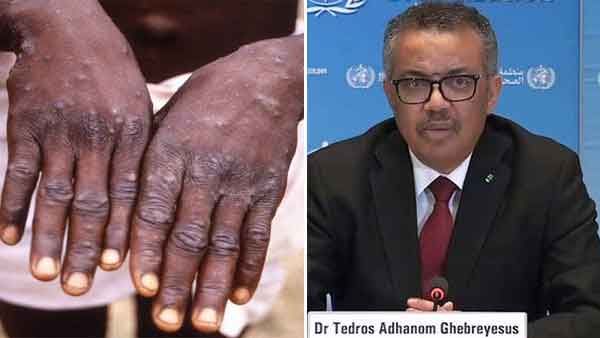 മങ്കിപോക്‌സിന്റെ പുതിയ പേര് ട്രംപ്-22 ആകുമോ? ലോകാരോഗ്യ സംഘടനക്ക് മുന്നില്‍ നിര്‍ദേശം