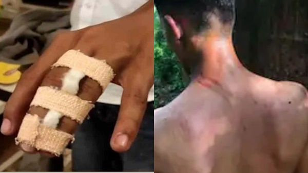 നാദാപുരം എംഇടി കോളേജില്‍ ക്രൂരമായ റാഗിങ്: ഒന്നാം വർഷ വിദ്യാർത്ഥിയുടെ കർണപുടം തകർന്നു