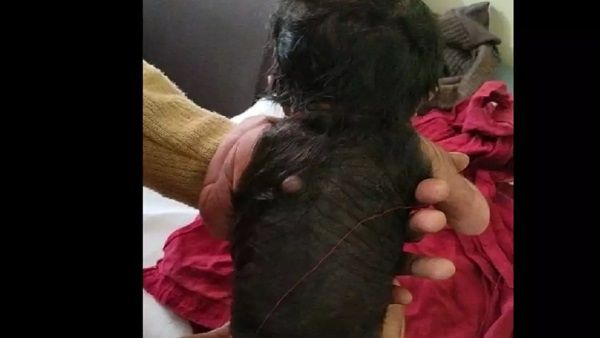 ശരീരത്തിന്റെ 60 ശതമാനവും രോമവുമായി ഇന്ത്യയില്‍ ഒരു കുഞ്ഞുപിറന്നു; ഡോക്ടര്‍മാരും അമ്പരന്നു