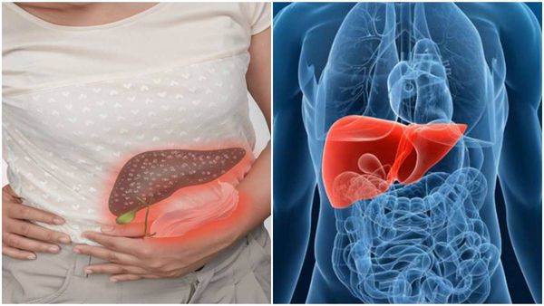 സ്ത്രീകളിലെ നോൺ ആൽക്കഹോളിക് ഫാറ്റി ലിവർ ഡിസീസ്, അറിയാം കാരണങ്ങളും ചികിത്സയും