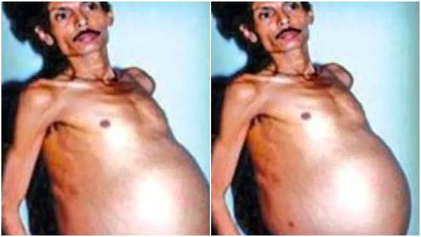 ​'ഗർഭിണിയായ പുരുഷൻ​'; ഇരട്ടസഹോദരനെ വയറ്റിലിട്ട് ജീവിച്ചത് 36 വർഷം; ഡോക്ടർ പോലും ഞെട്ടി!