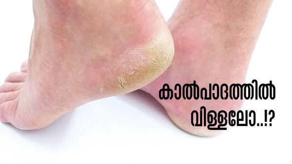 പാദങ്ങള്‍ വിണ്ടുകീറുന്നോ..? പേടിക്കേണ്ട, വീട്ടിലുണ്ടല്ലോ ഉറപ്പായും ഫലം തരുന്ന പരിഹാരം