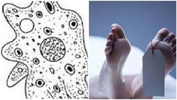 കോഴിക്കോട്ട് 13കാരി മരിച്ചത് അമീബിക് മസ്തിഷ്ക ജ്വരം ബാധിച്ച്; സ്ഥിരീകരണം