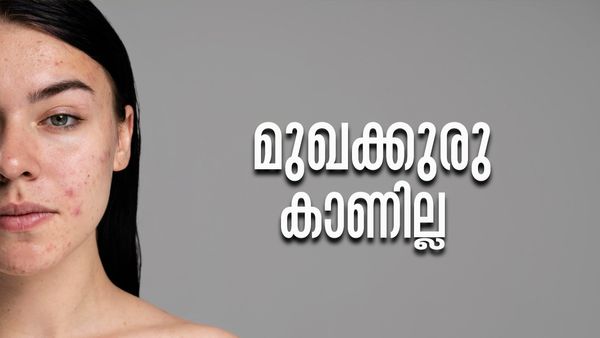 മുഖക്കുരു കാരണം ആത്മവിശ്വാസം നഷ്ടപ്പെട്ടോ? മറയ്ക്കാന്‍ ഇതാ ചില പൊടിക്കൈകള്‍