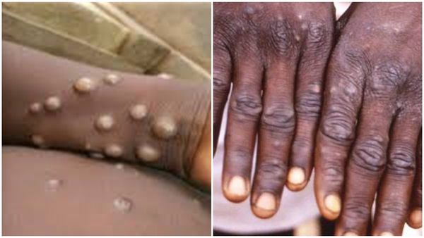 ഇന്ത്യയിലും മങ്കിപോക്സ്?; ഒരാൾ നിരീക്ഷണത്തിൽ, സാമ്പിളുകൾ ശേഖരിച്ചു