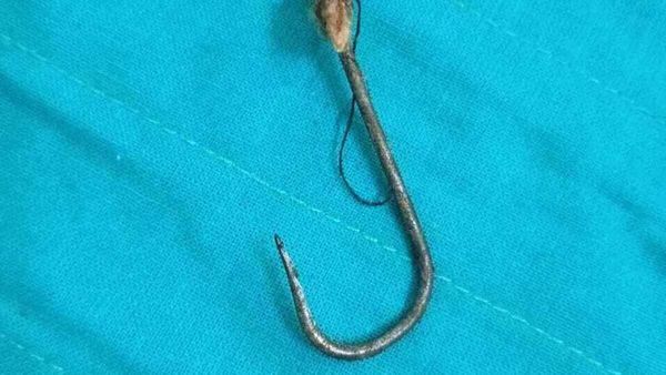 മത്സ്യചൂണ്ട കണ്‍പോളയിലേക്ക് തുളച്ചു കയറി; യുവതിക്ക് രക്ഷകരായി ഡോക്ടര്‍മാരും ജീവനക്കാരും