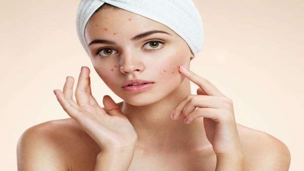 മുഖക്കുരു വന്ന് മുഖത്ത് മുഴുവൻ പാടാണോ? ഇങ്ങനെ ചെയ്ത് നോക്കൂ, മുഖം കൂടുതൽ സുന്ദരമാകും