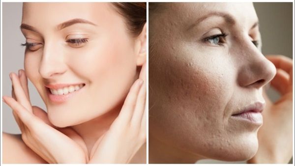 വിറ്റാമിന്‍ ഇ ഗുളികയിലെ എണ്ണ ഇങ്ങനെ പുരട്ടൂ; കണ്ണിനു ചുറ്റുമുള്ള കറുപ്പ് എളുപ്പത്തില്‍ അകറ്റാം