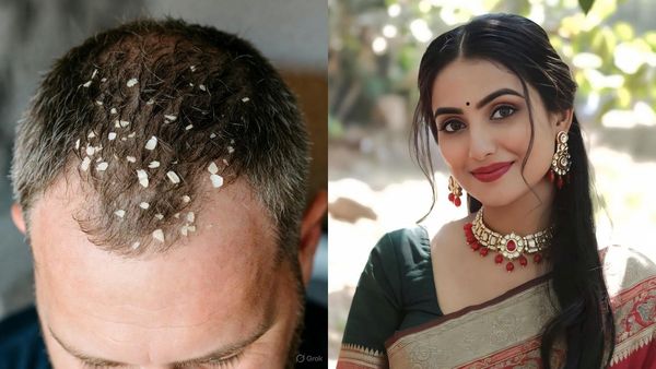 എന്തൊക്കെ പരീക്ഷിച്ചിട്ടും താരൻ മാത്രം പോകുന്നില്ലേ? ഇതാണ് കാരണം, താരനെ തുരത്താൻ എളുപ്പവഴിയുണ്ട്