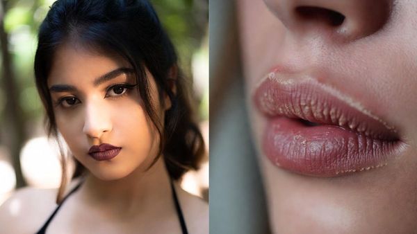 എന്തൊക്കെ ചെയ്തിട്ടും ചുണ്ടിലെ കറുപ്പ് നിറം മാറുന്നില്ലേ? പരിഹാരം കൺമുന്നിലുണ്ട്, ഇതാ 5 എളുപ്പവഴികൾ