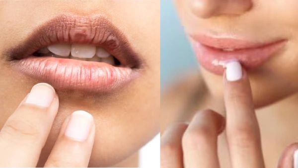 തണുപ്പത്ത് വരണ്ട ചുണ്ടുകളിലെ തൊലി പറിച്ചെടുക്കുന്ന ശീലം നിങ്ങള്‍ക്കുണ്ടോ? ഇതാണ് അതിനുള്ള പരിഹാരം