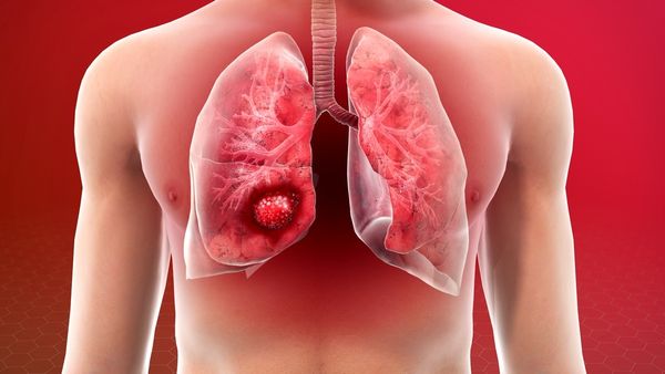 ജാഗ്രത! പുകവലിക്കാത്തവരിലും ശ്വാസകോശ കാൻസർ പടരുന്നു; ഈ ലക്ഷണങ്ങൾ അവഗണിക്കരുത്