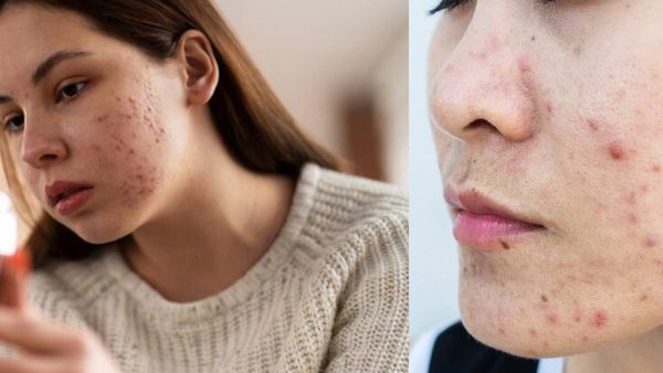 ടീനേജിലെ പെട്ടെന്നുള്ള മുഖക്കുരുവും എണ്ണമയമുള്ള മുടിയും; മാതാപിതാക്കള്‍ ചെയ്യേണ്ടത് ഇതാണ്