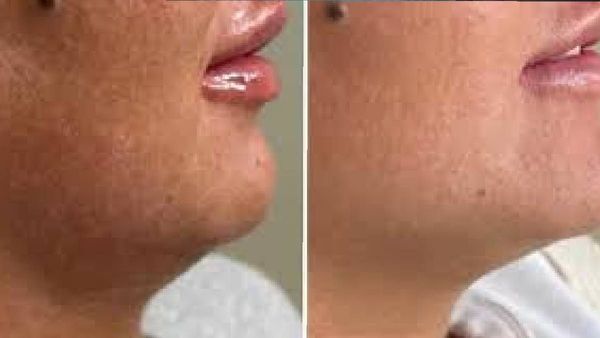 ഫേസ് യോഗ ചെയ്താല്‍ ഇരട്ടത്താടി ഇല്ലാതാകുമോ? ഈ പ്രചാരണത്തിന് പിന്നിലെ സത്യം ഇതാണ്