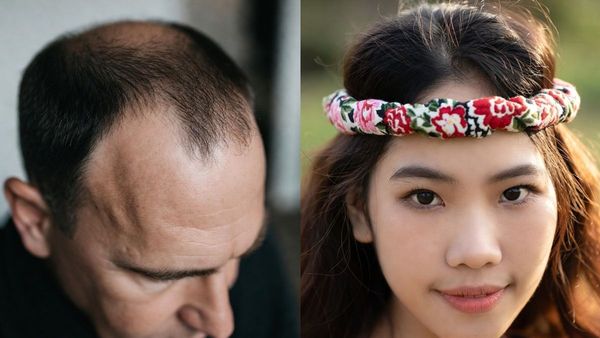 കഷണ്ടി വരാൻ പോകുന്നത് എങ്ങനെ മുൻകൂട്ടി അറിയാം? നിങ്ങൾക്ക് ഈ ലക്ഷണങ്ങളുണ്ടോ എന്ന് നോക്കൂ