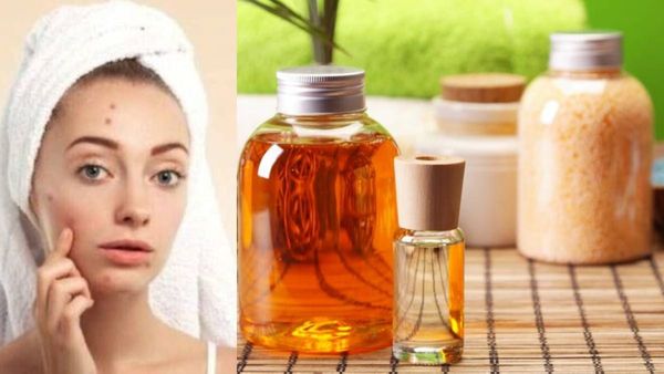 കുങ്കുമാദി തൈലം എല്ലാ ചര്‍മ്മക്കാര്‍ക്കും ഫലിക്കുമോ? മുഖക്കുരു ഉള്ളവര്‍ അറിഞ്ഞിരിക്കാന്‍