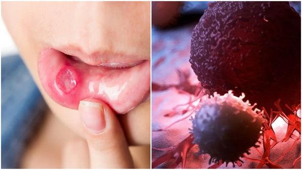 വായിൽ ഈ ലക്ഷണങ്ങൾ ഉണ്ടോ? എങ്കിൽ സൂക്ഷിക്കുക! മാരക രോഗമാകാം