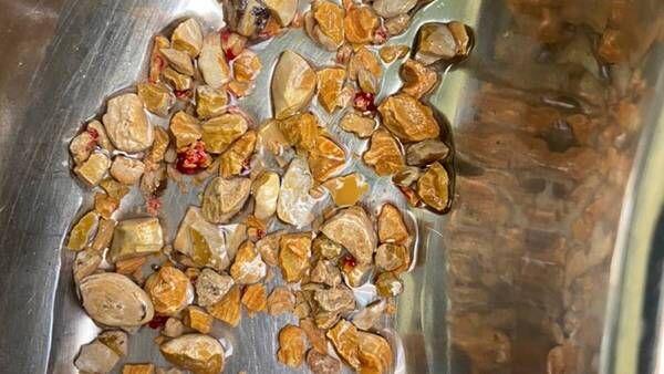 କିଡନୀରୁ ବାହାରିଲା 206 ଖଣ୍ଡ ଷ୍ଟୋନ