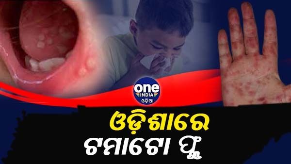 ଓଡ଼ିଶାରେ ଟମାଟୋ ଫ୍ଲୁ, ୨୬ HFMD ପଜିଟିଭ ଚିହ୍ନଟ