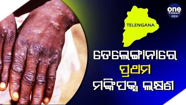 ତେଲେଙ୍ଗାନାରେ ସାମ୍ନାକୁ ଆସିଲା ପ୍ରଥମ ମଙ୍କିପକ୍ସ ଲକ୍ଷଣ, କୁଏତରୁ ଫେରିଥିଲେ ବ୍ୟକ୍ତି