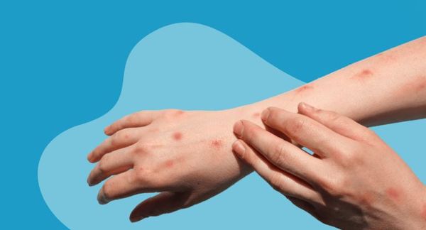 ମଙ୍କିପକ୍ସ ନେଇ ସରକାରଙ୍କ ପ୍ରସ୍ତୁତି ଆରମ୍ଭ ,ଜିଲ୍ଲାସ୍ତରରେ ସଚେତନତା ପାଇଁ ସ୍ୱାସ୍ଥ୍ୟ ଅଧିକାରୀଙ୍କୁ ନିର୍ଦ୍ଦେଶ