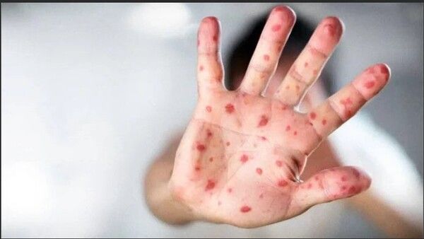 ଦେଶରେ ଟମାଟୋ ଫ୍ଲୁ ଭୟ, ଓଡିଶାରେ ବି ସଂକ୍ରମିତ ଚିହ୍ନଟ