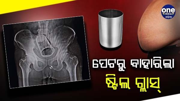 ମଳଦ୍ବାର ପଟେ ଜବରଦସ୍ତି ଭର୍ତ୍ତି କରାଇ ଦେଲେ ଷ୍ଟିଲ ଗ୍ଲାସ