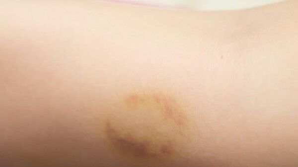 ଶ୍ରଦ୍ଧା ମର୍ଡର ମିଷ୍ଟ୍ରୀ: ମାଡଦାଗ ଏବଂ ଇଣ୍ଟରନାଲ ଇନଜ୍ୟୁରୀ ଯୋଗୁଁ ହସ୍ପିଟାଲରେ ଭର୍ତ୍ତିଥିଲେ ଶ୍ରଦ୍ଧା