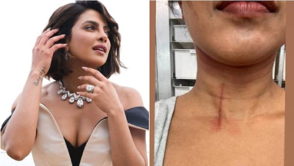 Priyanka Chopra Injured: ଆହତ ହେଲେ ଦେଶୀ ଗର୍ଲ, ଏପରି ଅନ୍ଦାଜରେ ଆସିଲେ ନଜର