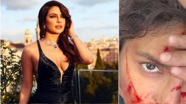 ଗ୍ଲୋବାଲ ଷ୍ଟାର୍‌ ପ୍ରିୟଙ୍କା ଚୋପ୍ରା ହେଲେ ଆହତ, ଫାଟିଲା ନାକ!