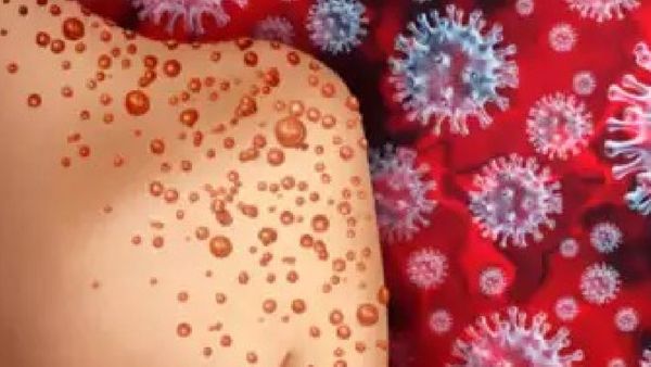 ଦେଶରେ ବୃଦ୍ଧି ପାଉଛି ମଙ୍କିପକ୍ସ, ରାଜ୍ୟମାନଙ୍କ ଲାଗି ନିୟମାବଳୀ ଜାରି କଲା କେନ୍ଦ୍ର