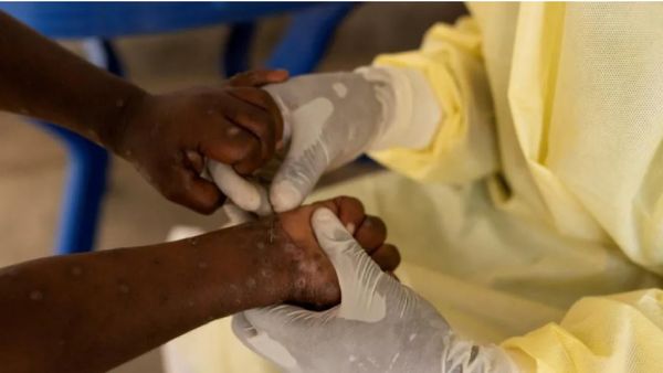 ଜାଣନ୍ତୁ ମଙ୍କିପକ୍ସରେ କେତେ ଜଣଙ୍କର ହେଲାଣି ମୃତ୍ୟୁ