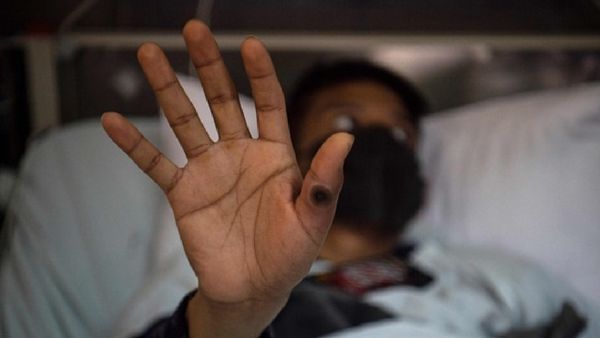 ସାବଧାନ! ଭାରତରେ ଚିହ୍ନଟ ହେଲା 'ମଙ୍କିପକ୍ସ'ର ନୂଆ ଭ୍ୟାରିଏଣ୍ଟର ପ୍ରଥମ ମାମଲା